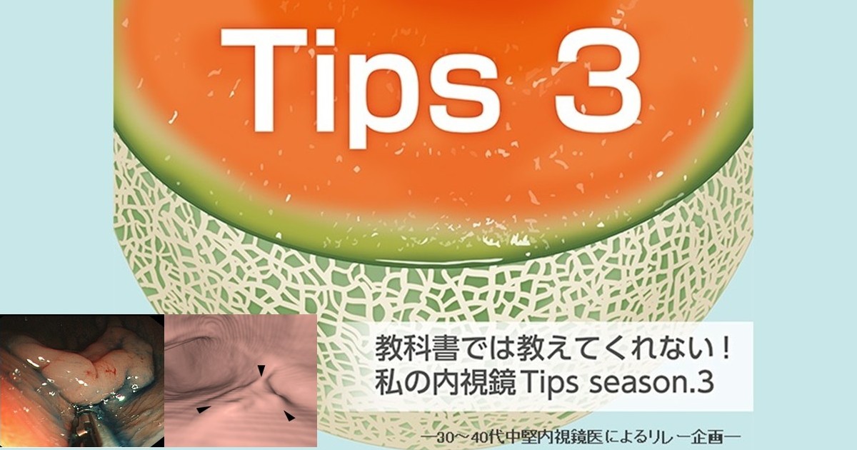 Tips 296「CT colonographyで見る内視鏡の死角」鶴丸 大介（九州大学大学院医学研究院臨床放射線科学分野）